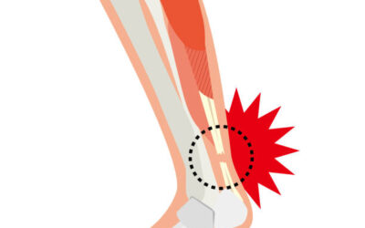 TENDON DE AQUILES