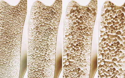 OSTEOPOROSIS